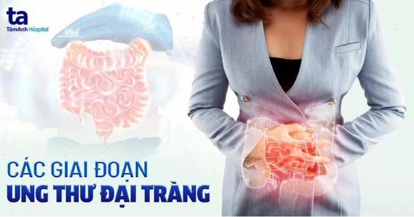 Bác sĩ đang nội soi tầm soát ung thư đại tràng