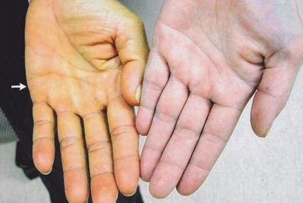 Bác sĩ theo dõi chỉ số sức khỏe bệnh nhân ung thư gan