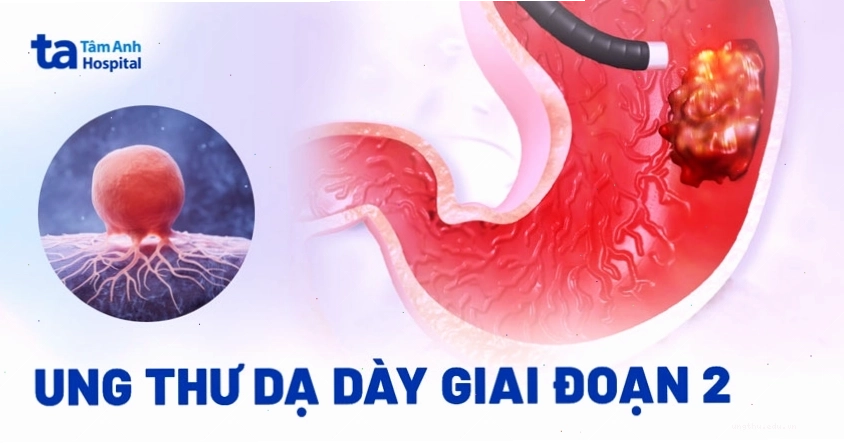 Bảng phân loại giai đoạn ung thư dạ dày theo hệ thống TNM
