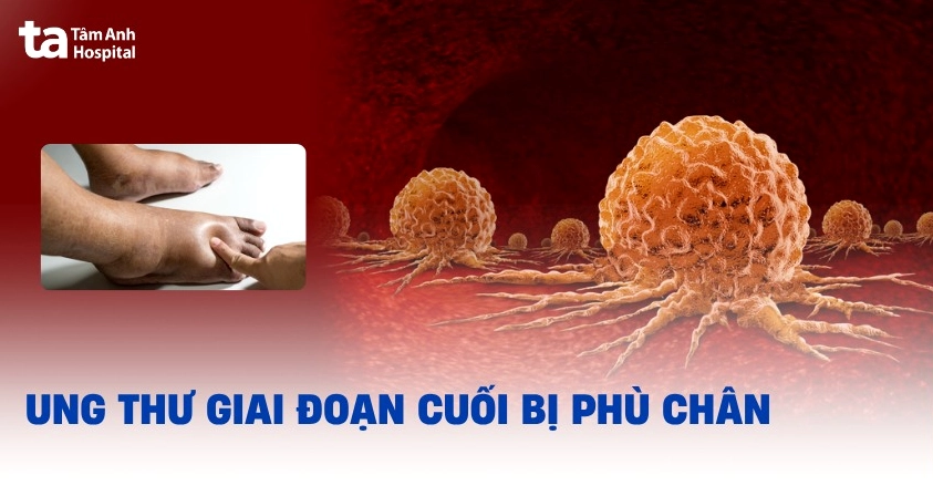 Bệnh nhân ung thư bị phù chân: Nguyên nhân và cách giảm nhẹ hiệu quả