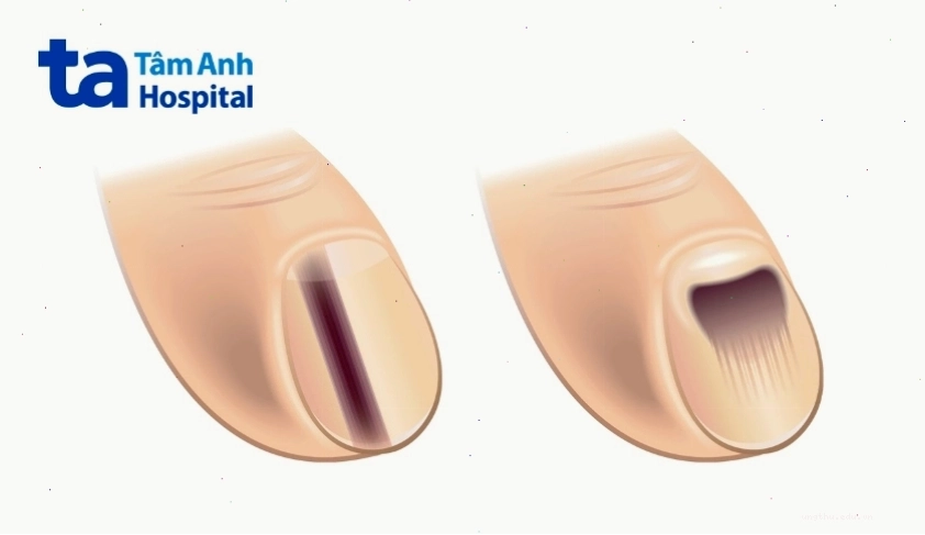 Bệnh ung thư hắc tố dưới móng nguy hiểm, cần phát hiện sớm
