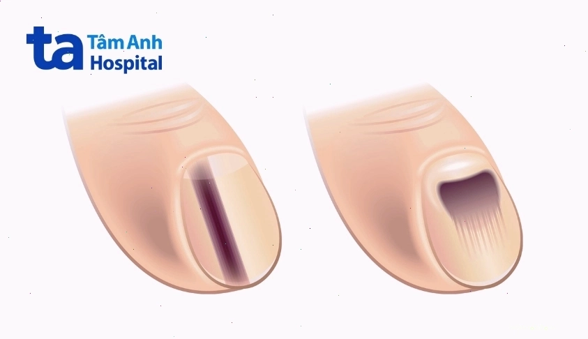 Bệnh ung thư hắc tố dưới móng nguy hiểm