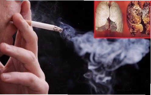 Biểu đồ so sánh tỷ lệ ung thư phổi theo nguyên nhân