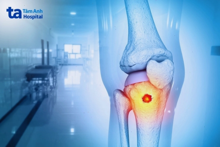 Biểu hiện của ung thư phổi di căn xương
