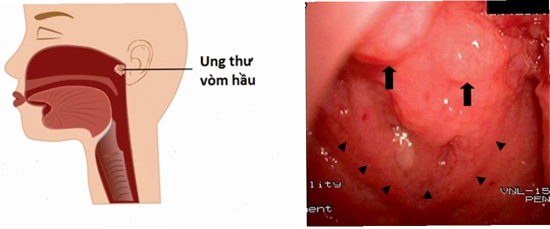 biểu hiện ung thư vòm mũi họng