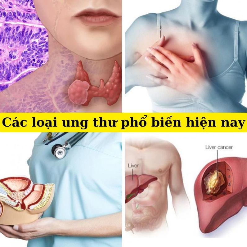 Các bệnh ung thư thường gặp ở Việt Nam và biện pháp phòng ngừa