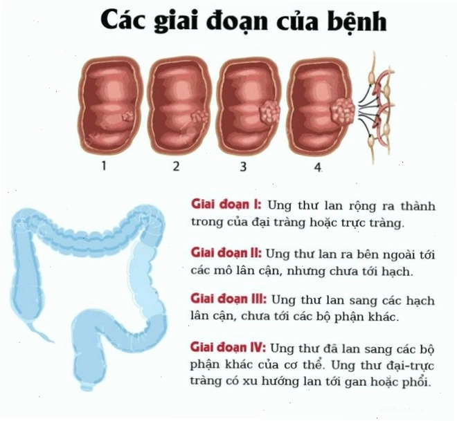 Các giai đoạn của ung thư đại tràng