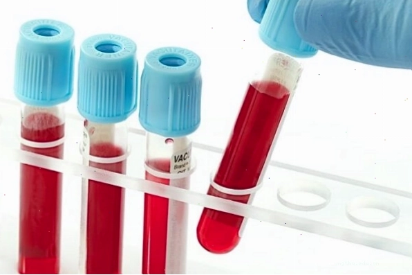 Các phương pháp chẩn đoán bệnh Leukemia là gì?