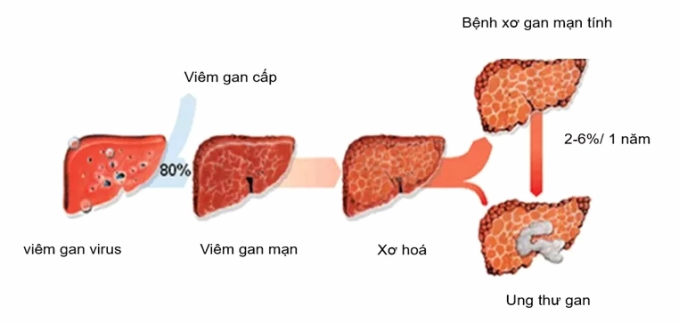 Các xét nghiệm ung thư gan: Khi nào cần thực hiện và chỉ số nào cần theo dõi