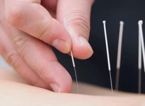 Châm cứu giúp hỗ trợ giảm đau và cải thiện sức khỏe