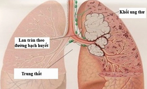 Chăm sóc người bệnh ung thư phổi: Hướng dẫn toàn diện và nhân văn
