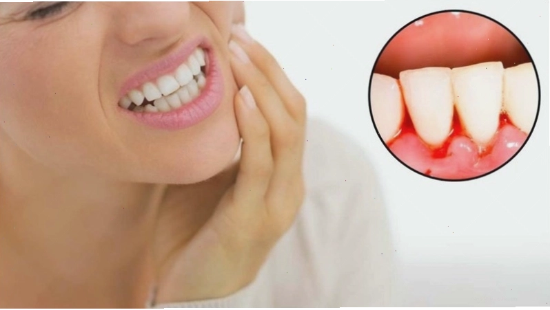 Chảy máu nướu kéo dài là dấu hiệu sức khỏe răng miệng đáng lo ngại