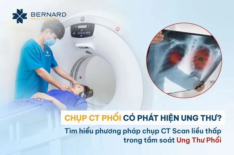 Chụp CT phổi có phát hiện ung thư không? Quy trình và lợi ích