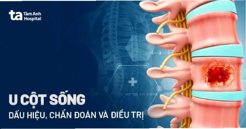 Chụp CT scan cột sống hỗ trợ chẩn đoán ung thư