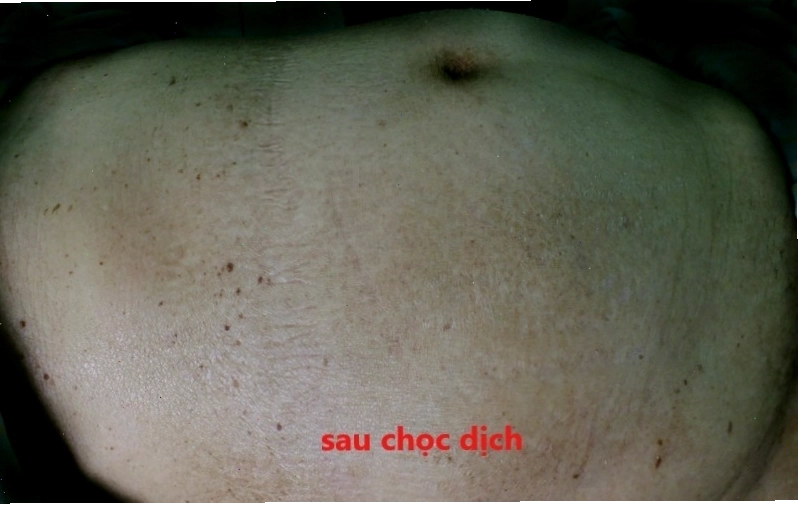 Cơ chế hình thành cổ trướng trong bệnh gan
