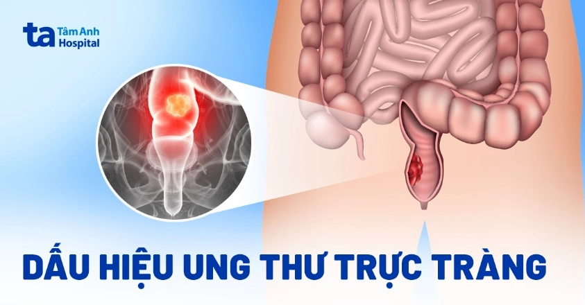 Dấu hiệu nhận biết ung thư đại trực tràng và trực tràng