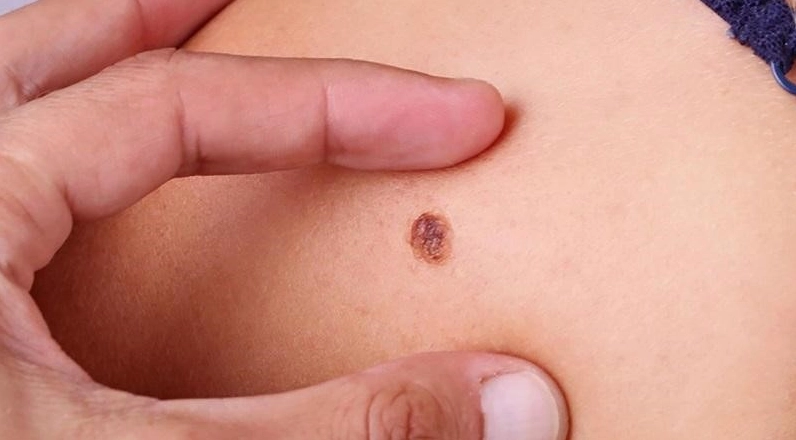 Dấu hiệu ung thư da giai đoạn đầu: Nhận biết sớm để điều trị kịp thời