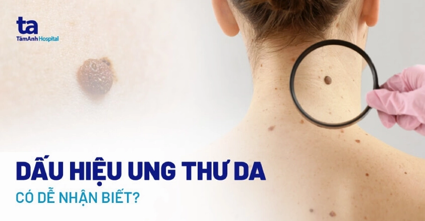 Dấu hiệu ung thư da tay: Nhận biết sớm để điều trị kịp thời