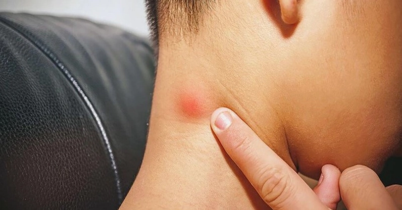 Dấu hiệu ung thư hạch ở trẻ em và cách nhận biết sớm