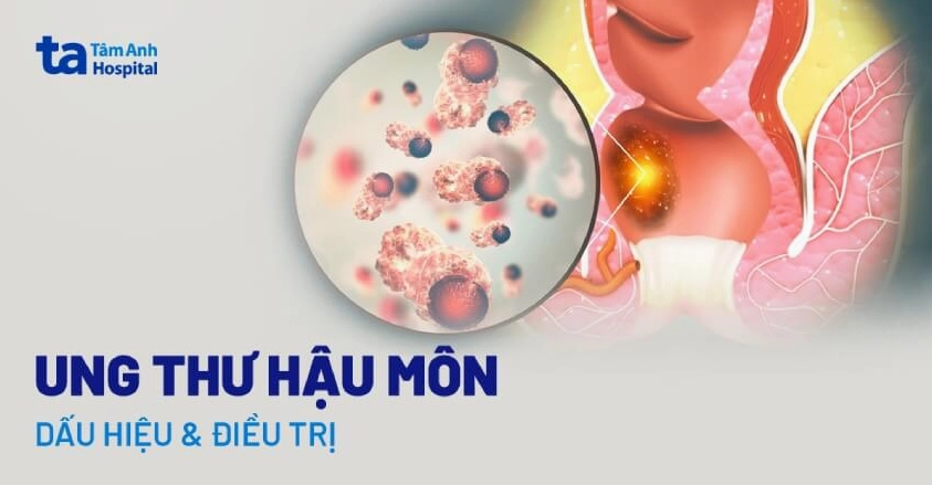 Dấu hiệu ung thư hậu môn giai đoạn đầu: Nhận biết sớm để tăng cơ hội chữa trị