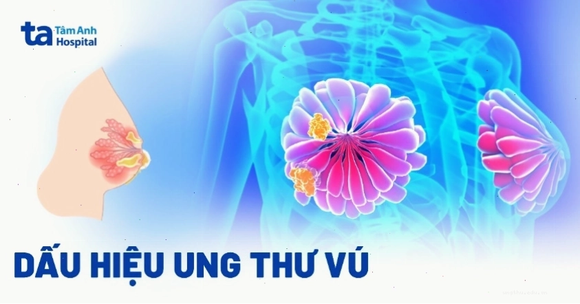 Dấu hiệu ung thư vú: tiết dịch núm vú bất thường