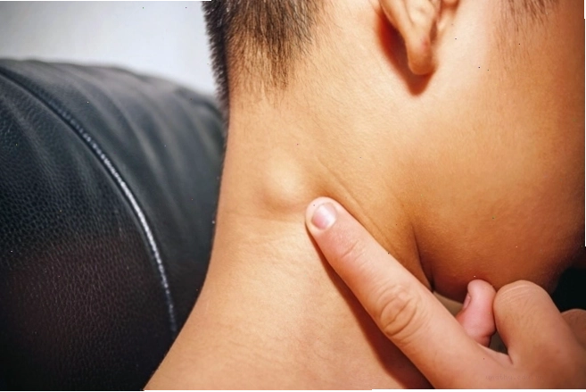 Hình ảnh khối u ung thư tuyến giáp kích thước 2cm