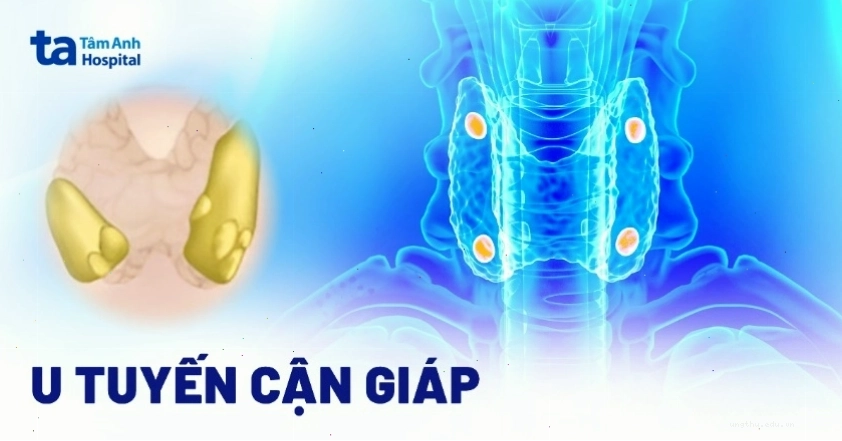 Hình ảnh minh họa cấu tạo tuyến cận giáp và khối u tuyến cận giáp