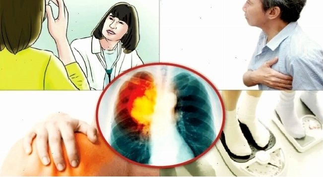 Hình ảnh minh họa hiện tượng ung thư phổi với các tế bào ác tính