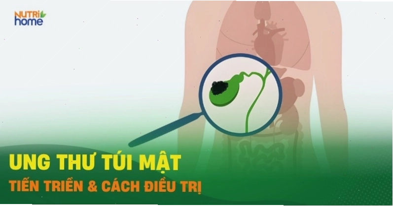 Hình ảnh minh họa khối u ung thư túi mật.