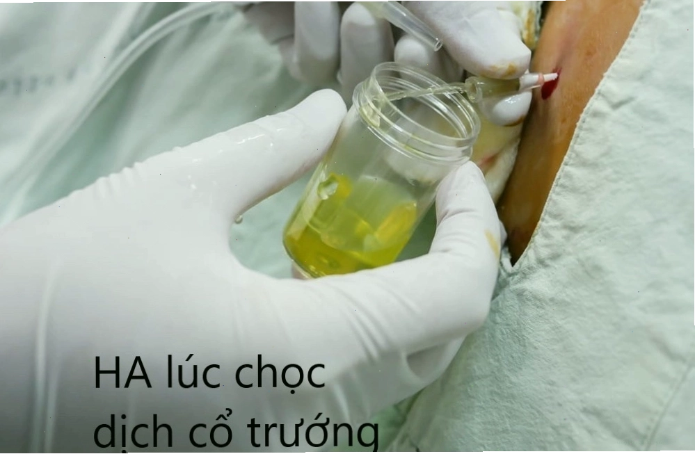 Hình ảnh minh họa người bệnh ung thư gan cổ trướng