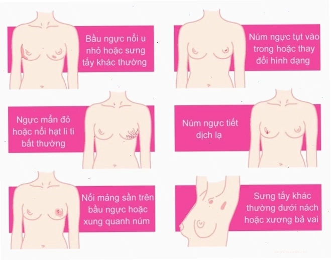 Hình ảnh minh họa quy trình sàng lọc ung thư vú