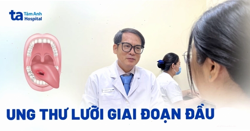 Hình ảnh minh họa ung thư lưỡi giai đoạn đầu