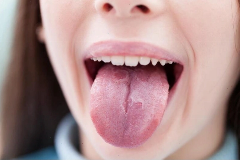 Hình ảnh minh họa ung thư lưỡi, nhấn mạnh tính không lây nhiễm