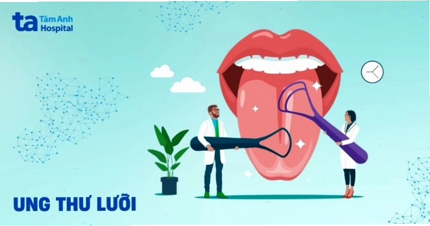 Hình ảnh minh họa ung thư lưỡi với các mảng đỏ bất thường