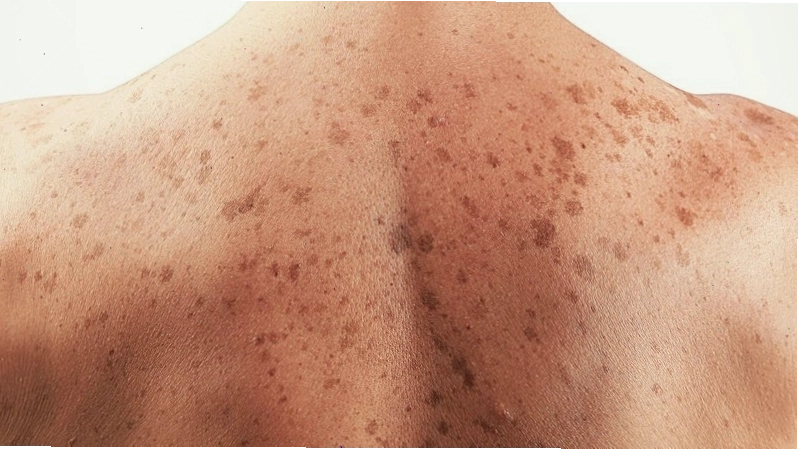 Hình ảnh minh họa ung thư tế bào vảy do nồng độ SCC tăng đột biến