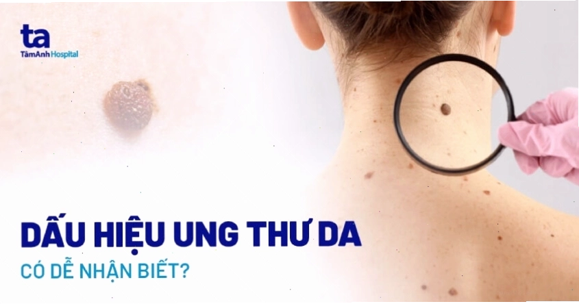 Hình ảnh minh họa về ung thư da