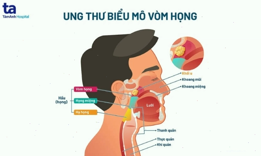 Hình ảnh mô phỏng cấu trúc ung thư vòm họng
