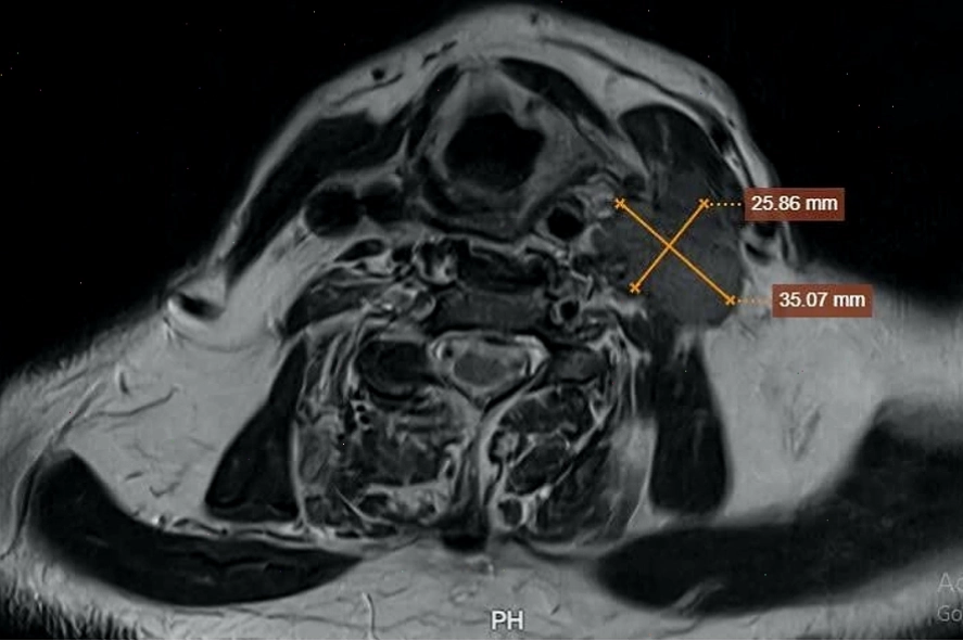Hình ảnh MRI ghi nhận khối u kích thước 2.5x3.5cm tại đáy lưỡi