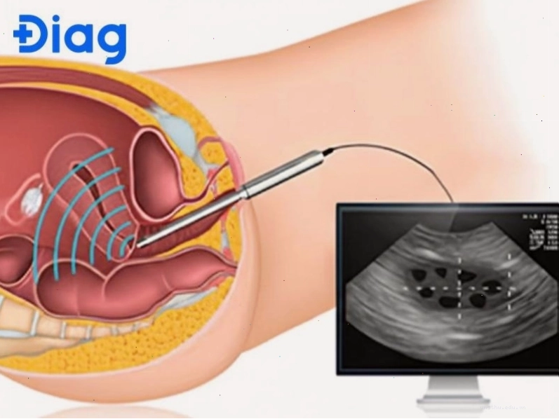 Hình ảnh siêu âm cho thấy cấu trúc bất thường tại cổ tử cung, gợi ý ung thư