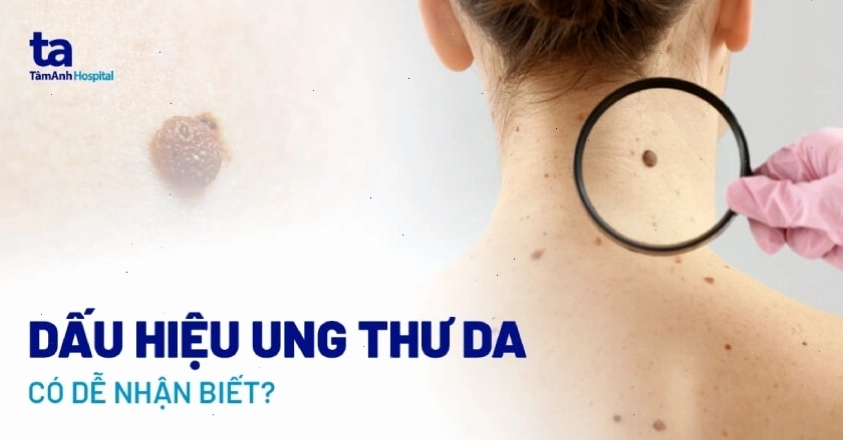 Hình ảnh tế bào hắc tố bất thường là nguyên nhân gây ung thư da hắc tố