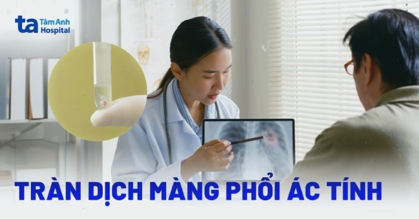 Hình ảnh tràn dịch màng phổi ác tính cho thấy sự tích tụ dịch bất thường trong khoang màng phổi
