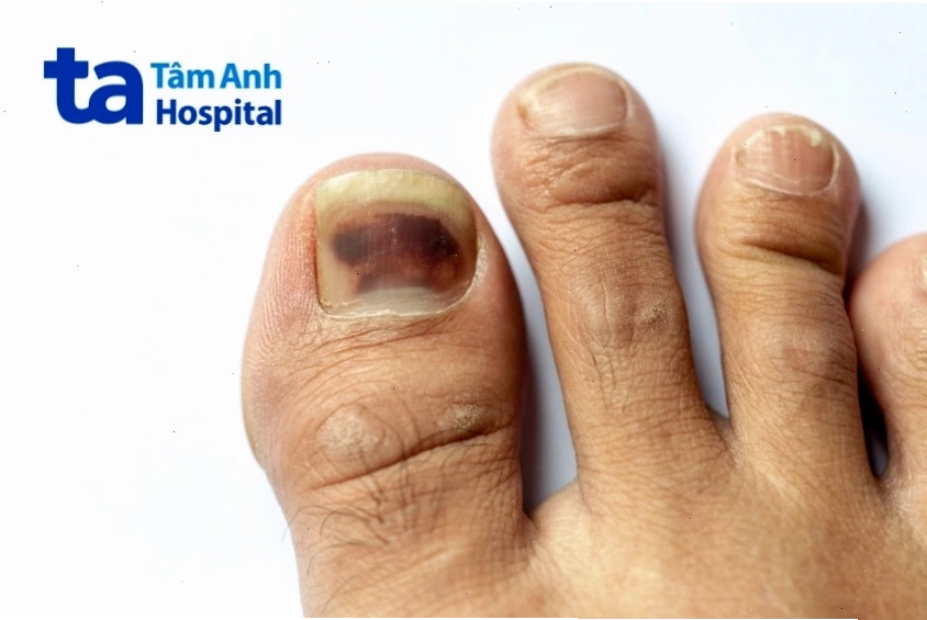 Hình ảnh ung thư hắc tố dưới móng chân