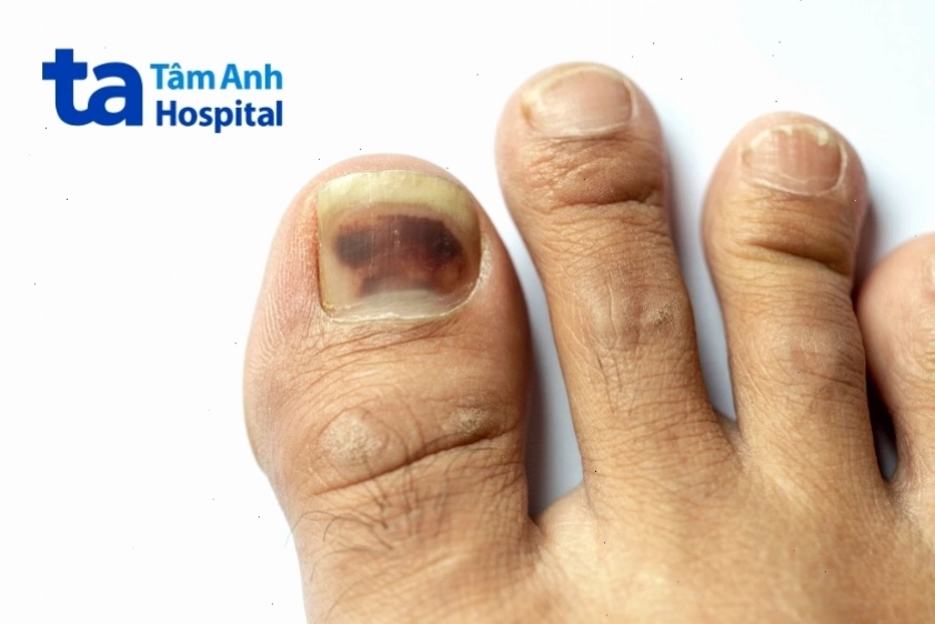 Hình ảnh ung thư hắc tố dưới móng chân với vệt màu nâu đen