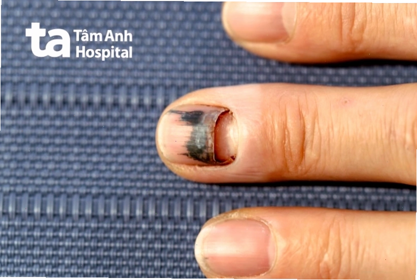 Hình ảnh ung thư hắc tố dưới móng tay chi tiết