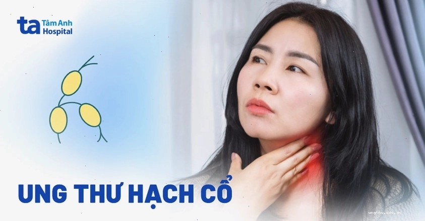 Hình ảnh ung thư hạch cổ với các hạch sưng to bất thường ở vùng cổ