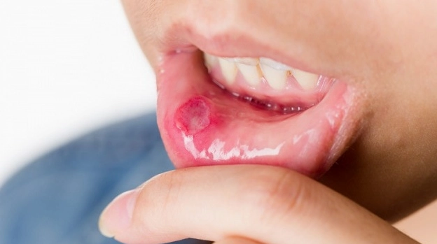 Hình ảnh ung thư lưỡi giai đoạn đầu và dấu hiệu nhận biết sớm