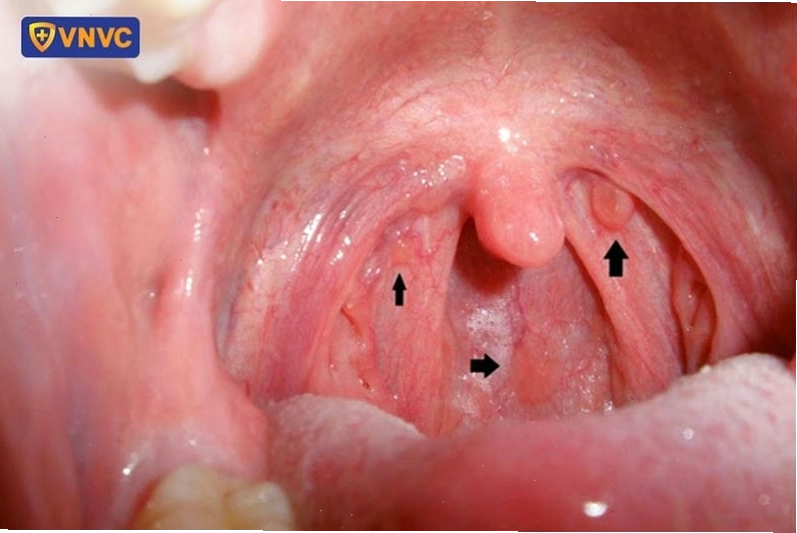 Hình ảnh ung thư vòm họng giai đoạn đầu với các dấu hiệu bất thường