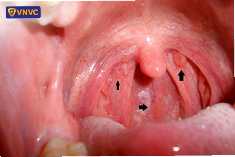 Hình ảnh ung thư vòm họng giai đoạn đầu với khối u nhỏ trong vòm họng