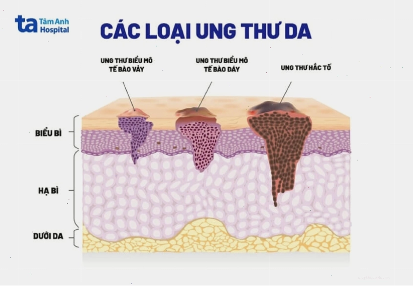 Hình ảnh vi thể ung thư tế bào hắc tố da
