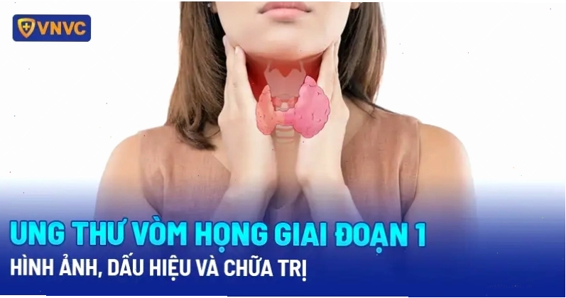 Hóa trị ung thư vòm họng giai đoạn 1